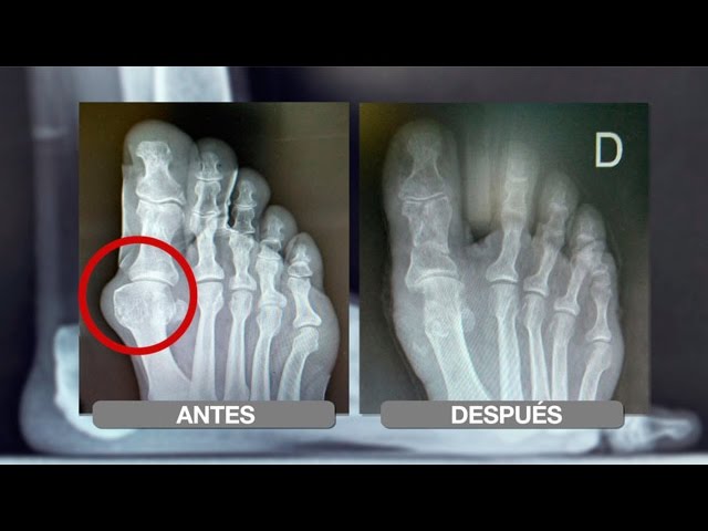 como-prevenir-y-tratar-los-juanetes-de-forma-efectiva