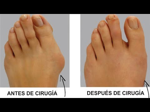 cómo-se-realiza-una-cirugía-de-juanetes-en-el-pie