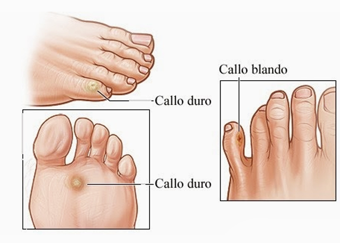 tratamientos-efectivos-para-callos-y-durezas-en-los-pies